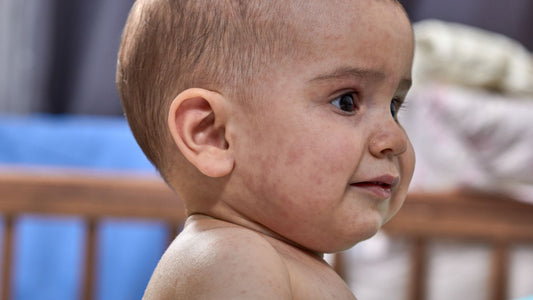 Un bébé avec des tâches roses sur le visage.