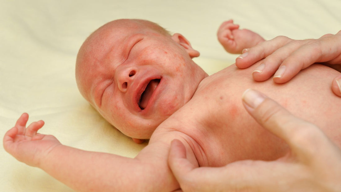 Un bébé avec des rougeurs sur le visage en train de pleurer